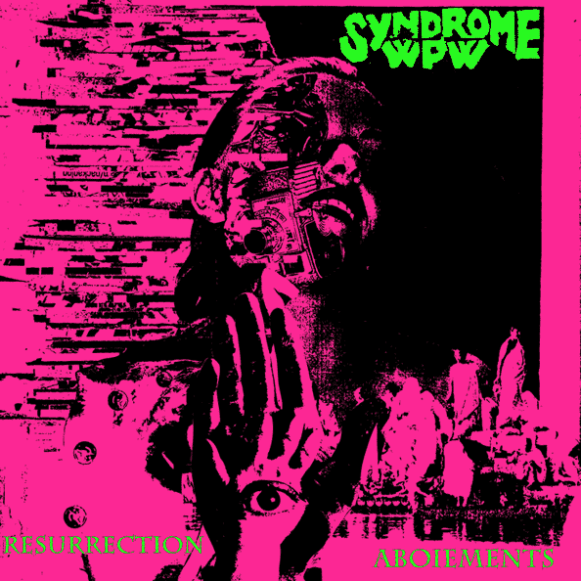 syndrome-wpw